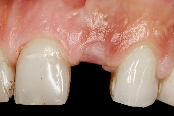 implant de chirurgie dentaire
 - Photo, image