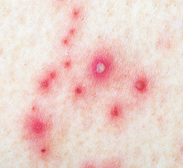 Herpes Zoster (Shingles) - Photo, Image