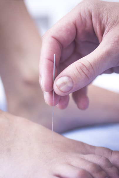 Doctor hand acupuncture needle dry needling - Photo, Image