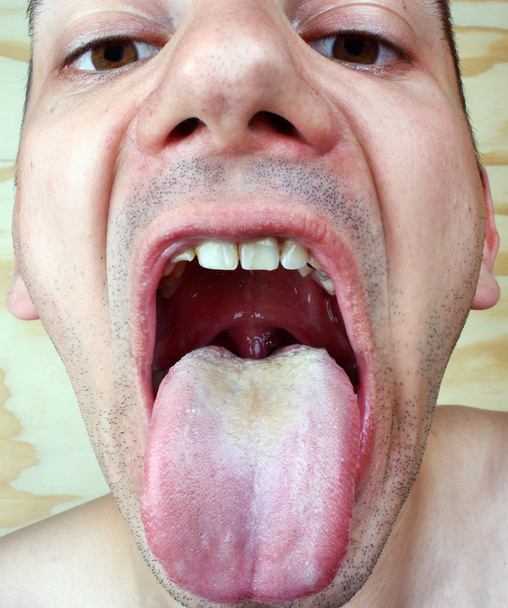 Infection bactérienne maladie langue
 - Photo, image