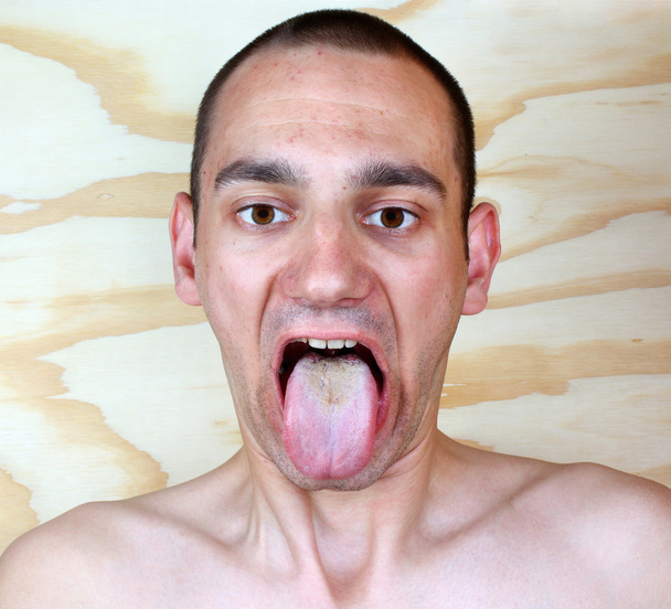 Infection tongue - Photo, Image