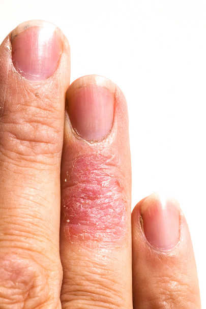 Chory Dematitis skóra alergiczna wysypka wyprysk palec - Zdjęcie, obraz