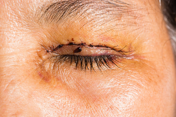 examen ocular, post blefaroplastia
 - Foto, imagen