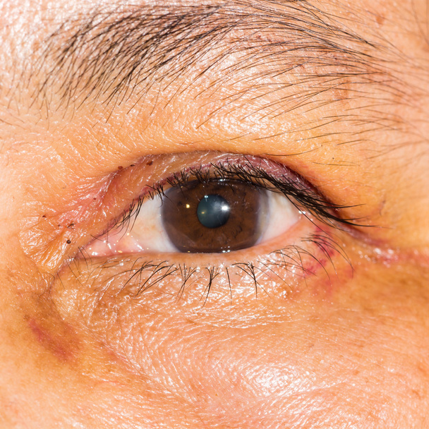 目の試験、ポストの眼瞼形成術 - 写真・画像