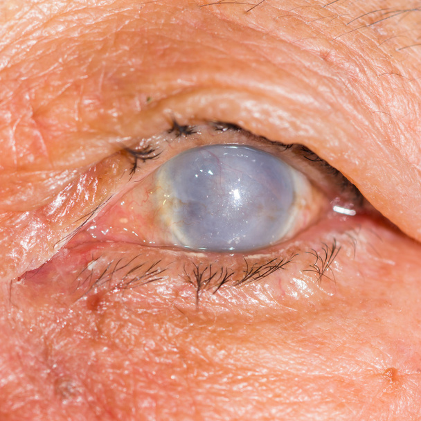 eye exam,  total opacity cornea - Photo, Image