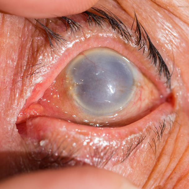 examen ocular, opacidad total de la córnea
 - Foto, Imagen