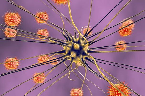 Neuronas y virus, encefalitis viral
 - Foto, imagen