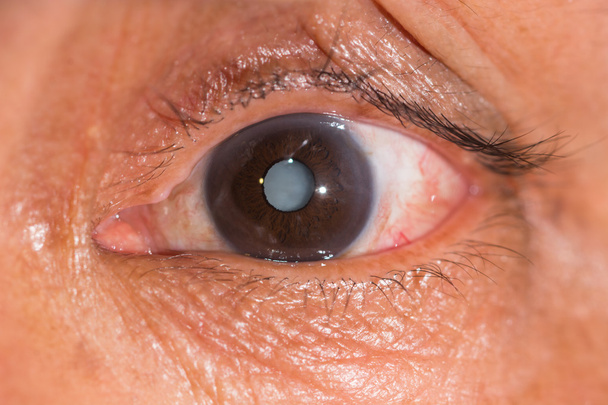 Durante o exame ocular
 - Foto, Imagem