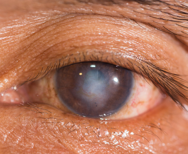 During eye examination - Photo, Image