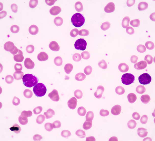 Akutní lymfoblastická leukémie (All) - Fotografie, Obrázek