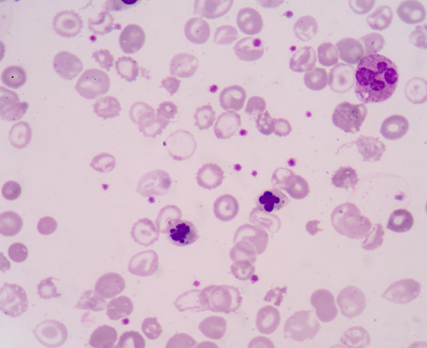 Jądrowych czerwonych krwinek, lub Nrbc, jest t czerwonych krwinek (Rbc) - Zdjęcie, obraz