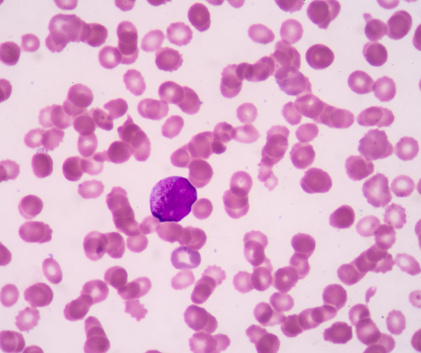 Promyelocyte. A rozmazu krwi jest często stosowany jako badanie następcze (CBC) - Zdjęcie, obraz