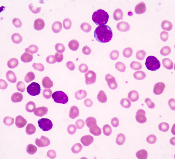 Leucemia linfoblastica acuta (LLA
) - Foto, immagini