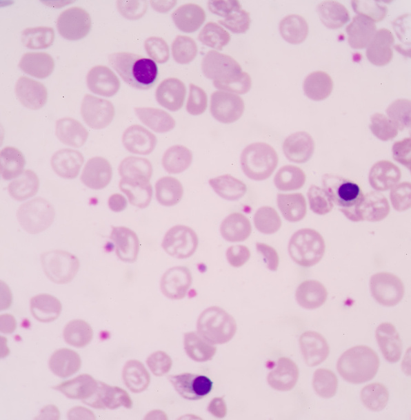 Μια εμπύρηνων ερυθροκυττάρων, ή Nrbc, είναι ένα κόκκινο κύτταρο αίματος (Rbc) t - Φωτογραφία, εικόνα
