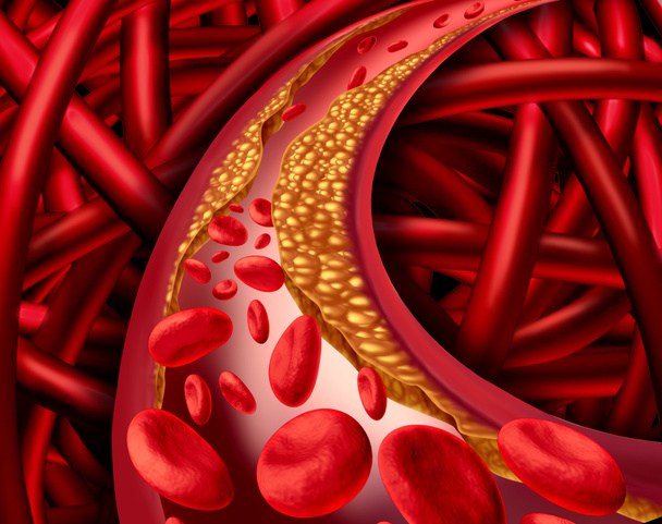 Artery Disease - Φωτογραφία, εικόνα