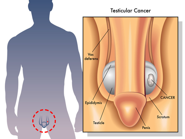 Medical Illustration of the effects of testicular cancer - Vector, Image