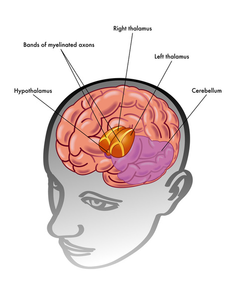 tálamo e hipotálamo y su posición dentro de la cabeza
 - Vector, imagen