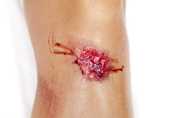 Close up on an scraped knee after fell down - Photo, Image