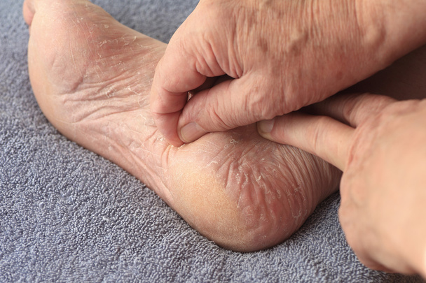 Чоловік чистить суху шкіру з ноги
 - Фото, зображення