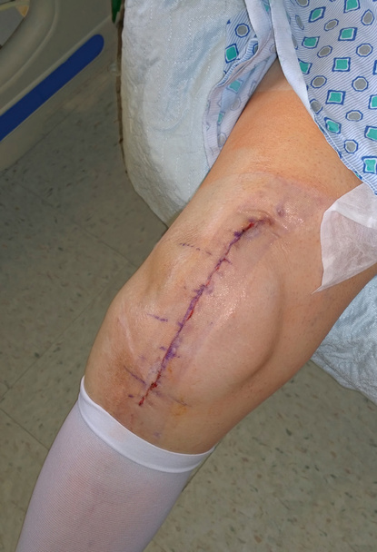 knie vervanging chirurgie litteken - Foto, afbeelding