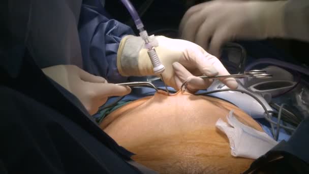 Roboterchirurgie der Gebärmutter - Filmmaterial, Video