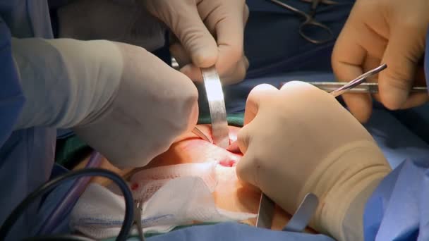 Chirurdzy operacji medycznej - Materiał filmowy, wideo