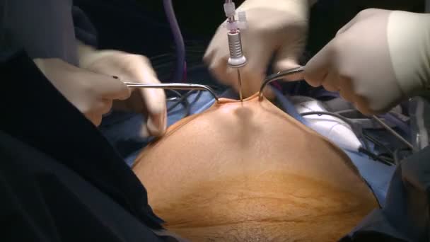 Chirurgie robotique de l'utérus
 - Séquence, vidéo
