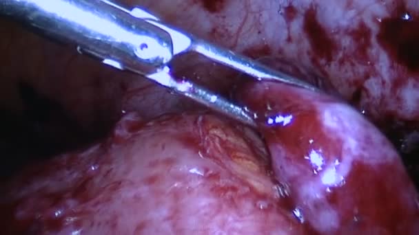 Fertőzés körülveszi egy megrepedt appendix - Felvétel, videó