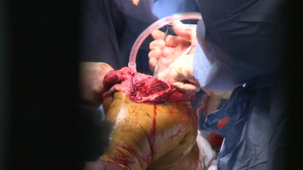 Chirurgen bei der Durchführung einer medizinischen Operation - Filmmaterial, Video