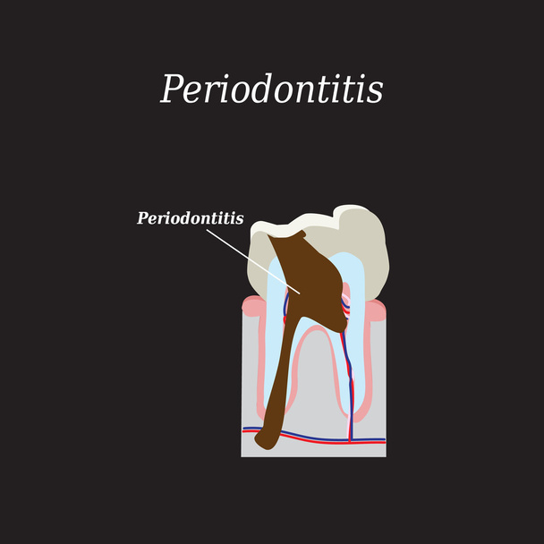 Periodontitis tooth. Vector illustration on a black background - Vector, Image