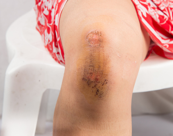 Τραύμα στο γόνατο από ατύχημα - Φωτογραφία, εικόνα