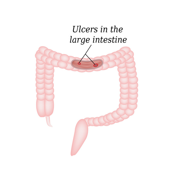 Ulcer in de darm. Zweren in de dikke darm. Vectorillustratie op geïsoleerde achtergrond - Vector, afbeelding