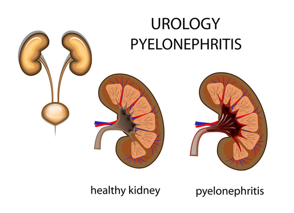 Urologie, Niere, Pyelonephritis - Vektor, Bild