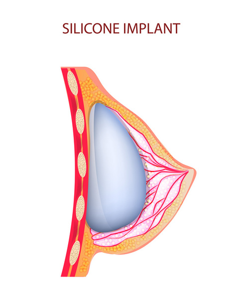 implant en silicone
 - Vecteur, image