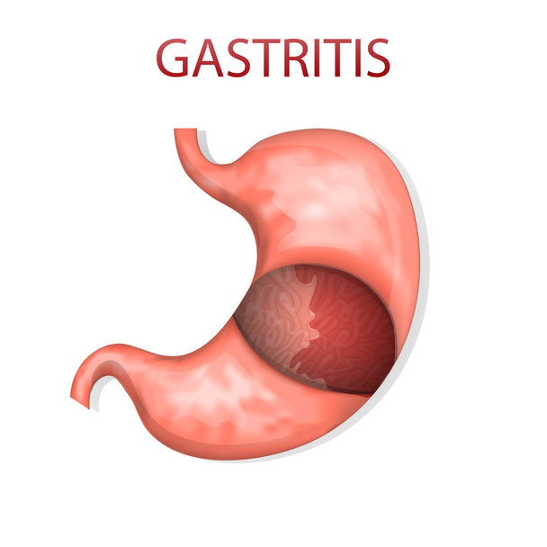 gyomor, gastritis - Vektor, kép