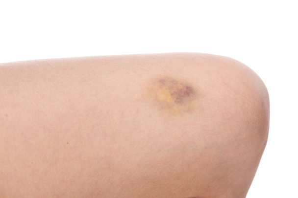 Bruise op vrouw been - Foto, afbeelding
