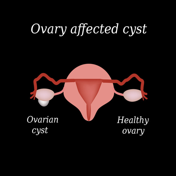 Een cyste in de eierstok. Bekken organen. Vectorillustratie op een zwarte achtergrond - Vector, afbeelding