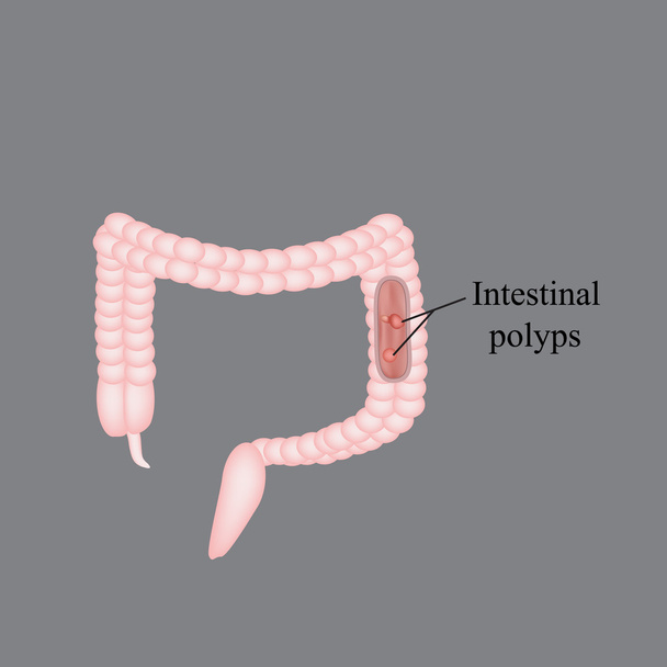 Um pólipo no intestino. Um pólipo no cólon. Ilustração vetorial sobre fundo cinzento
 - Vetor, Imagem