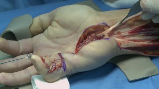 Chirurgia na sali operacyjnej - Materiał filmowy, wideo