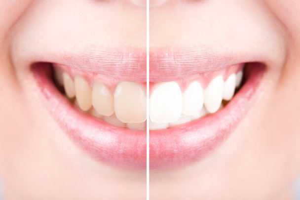 Yakın çekim diş kadın arasında önce ve sonra diş fırçası. - Fotoğraf, Görsel