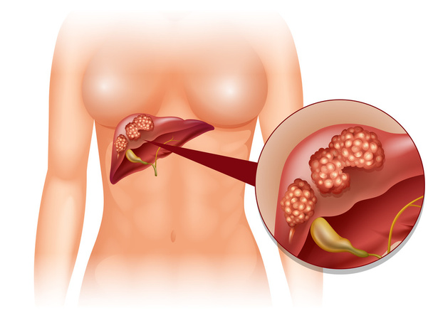 Diagrama del cáncer de hígado en detalle
 - Vector, imagen