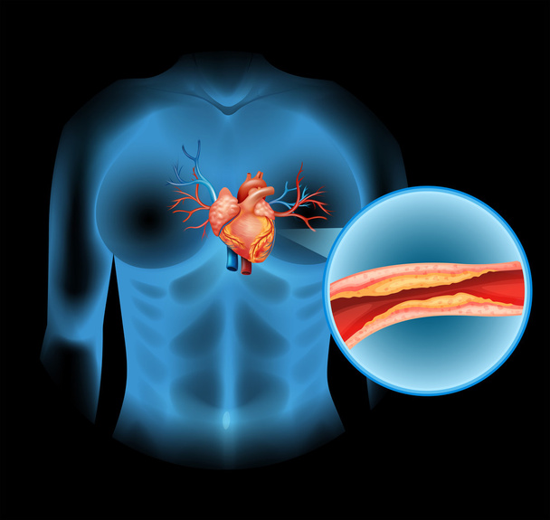 Заболевания сердца, вызванные холестерией
 - Вектор,изображение