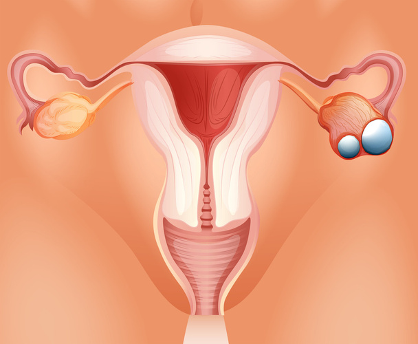 Overian cancer diagram in detail - Vector, Image