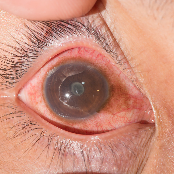 eye exam, posterior synechia - Photo, Image