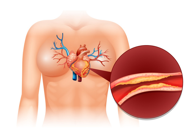 Heart Cholesteral in human - Vektor, obrázek