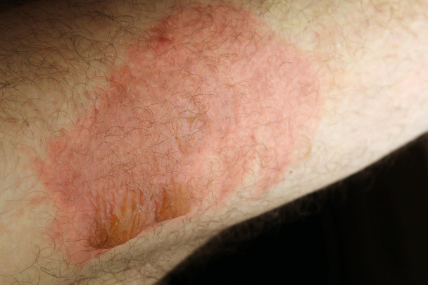 Thermal injuries. Burn the legs of the second degree - 写真・画像