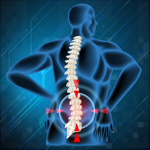 Wirbelsäule zeigt Rückenschmerzen - Vektor, Bild