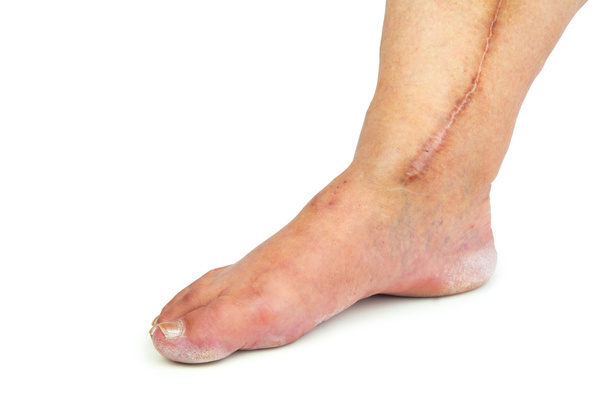 Perna humana com cicatriz pós-operatória de cirurgia cardíaca
 - Foto, Imagem