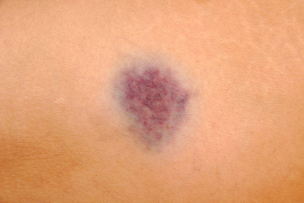 Close up of bruise on wounded woman leg skin. Gender violence concept. - Photo, Image