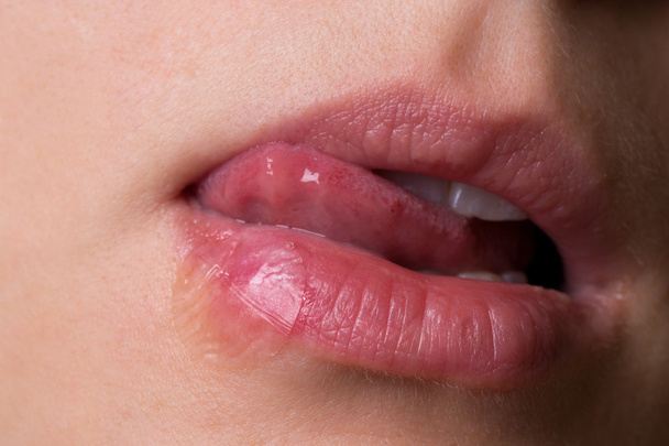 patch de traitement de l'herpès sur la lèvre
 - Photo, image